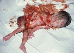 Baby killed during third trimester abortion.