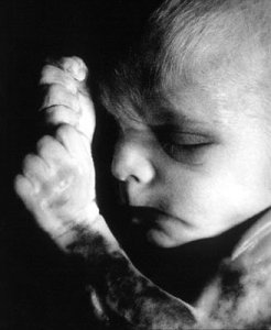 Third trimester abortion