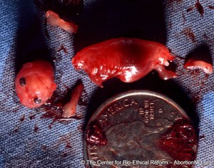 First trimester abortion