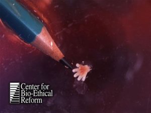 Hand of a first trimester abortion victim.