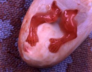 First trimester abortion